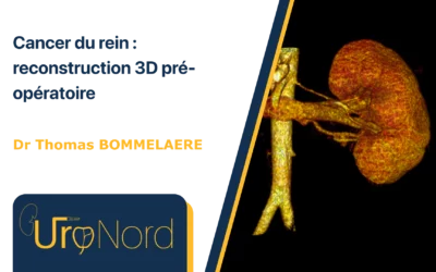 Cancer du rein : reconstruction 3D