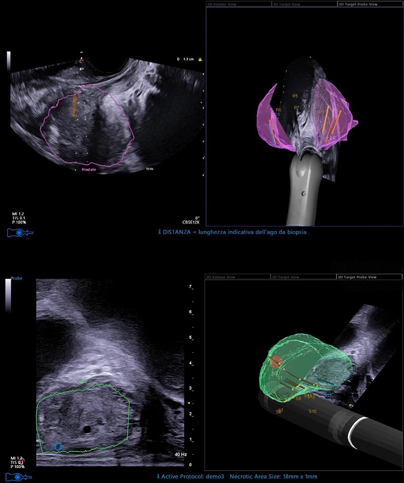 Image D'une Échographie Prostatique Pour Biopsie Transperineale